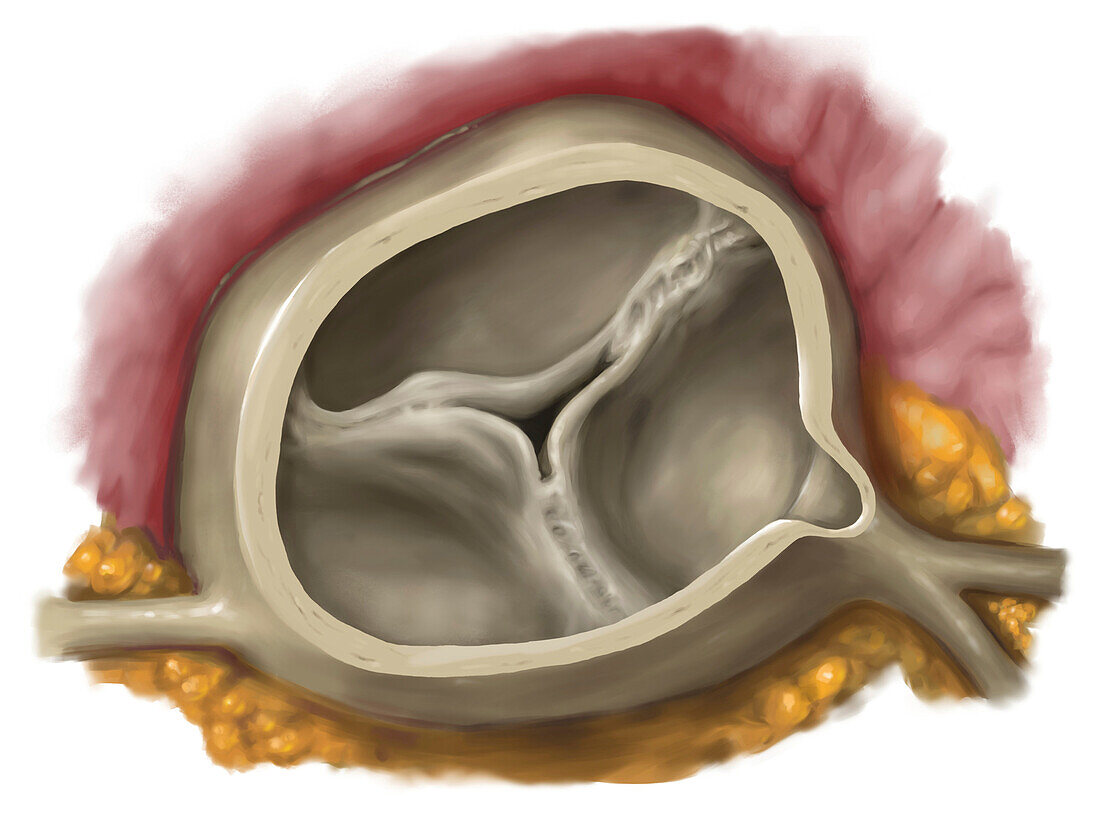 Narrowing and insufficiency of an aortic valve, illustration