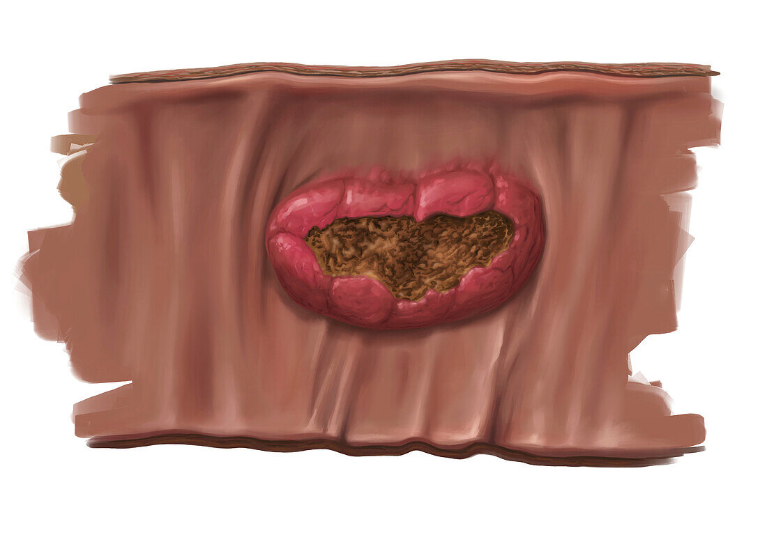 Inflamed Peyer's patch, illustration