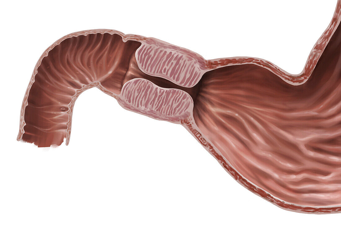 Pyloric stenosis, illustration