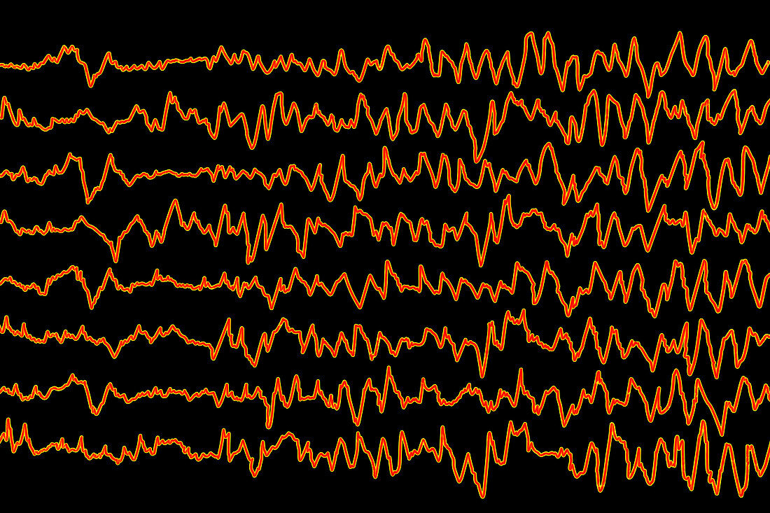 Brain waves in migraine, illustration