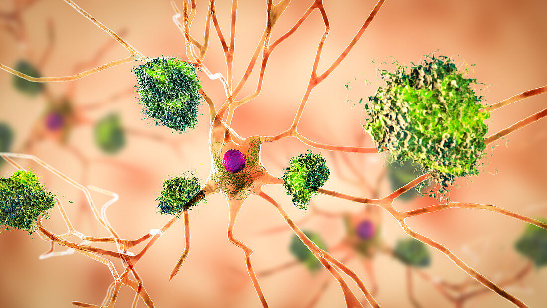 Nerve cells affected by Alzheimer's disease, illustration