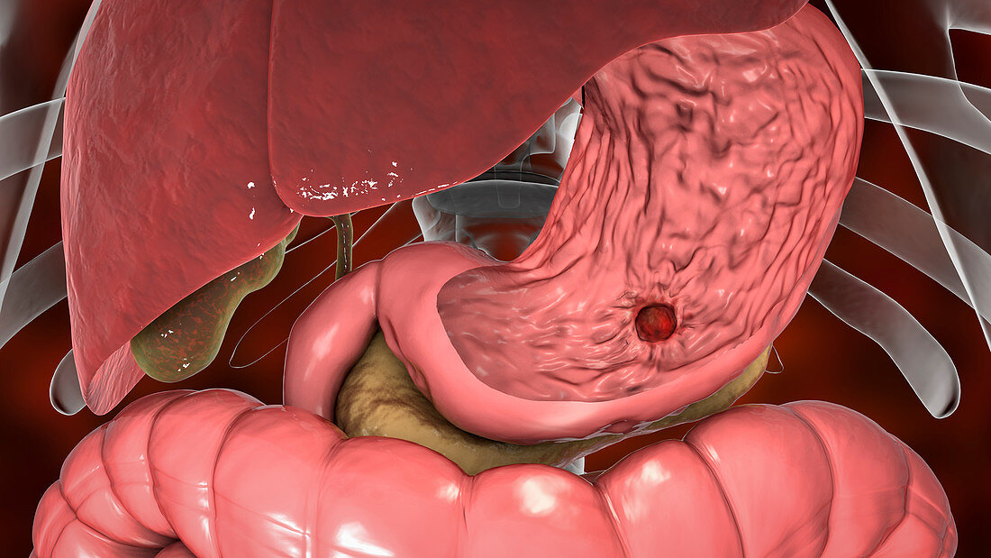 Gastric ulcer, illustration
