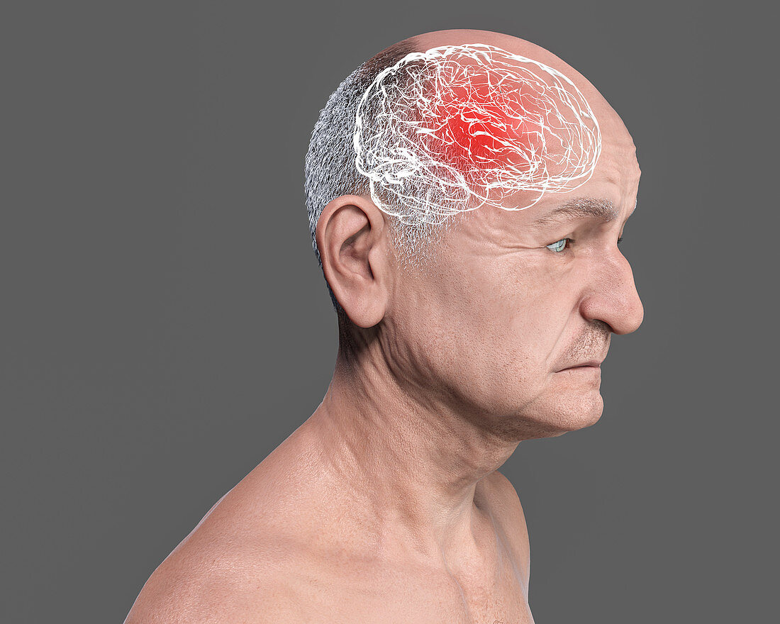 Elderly man's brain in dementia, conceptual illustration