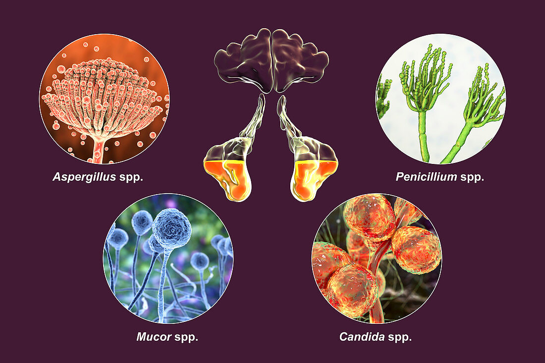 Sinusitis, illustration