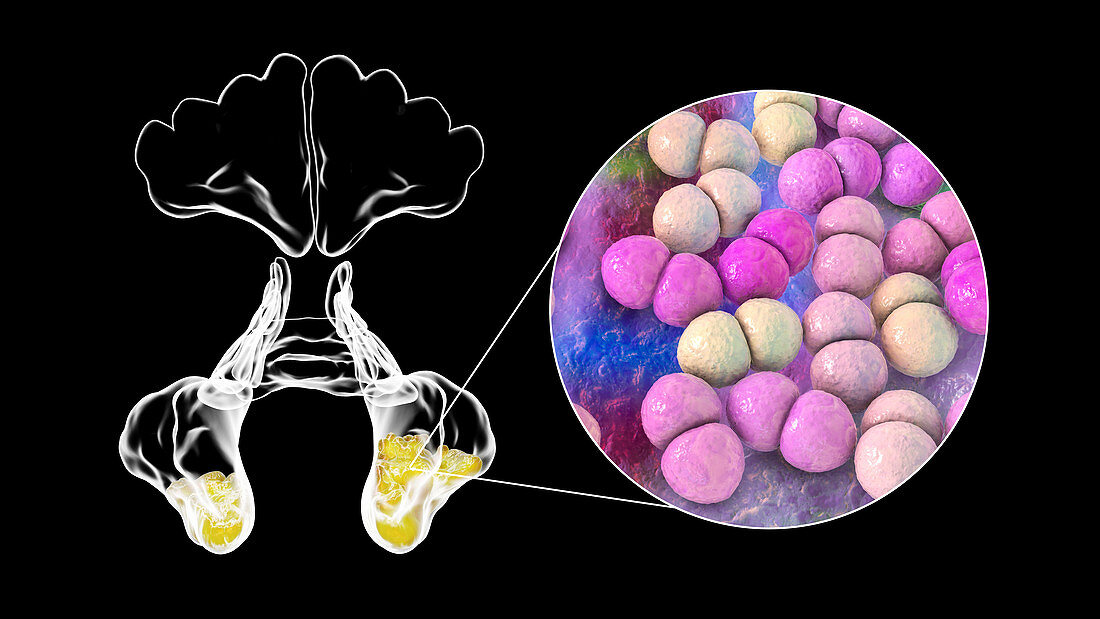 Sinusitis, illustration