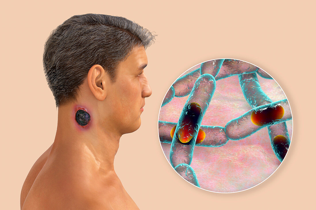 Cutaneous anthrax, illustration