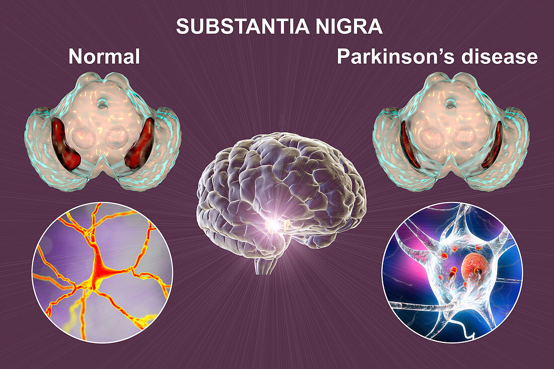 Substantia nigra in Parkinson's disease, illustration