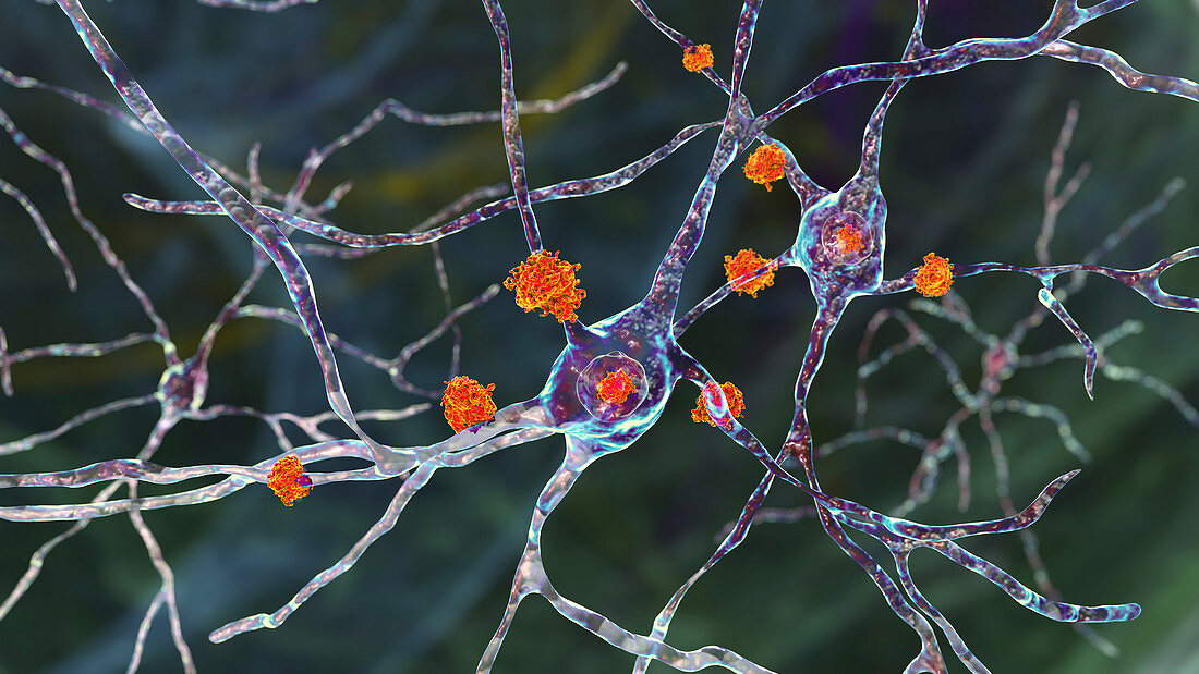 Neuronal inclusions in Huntington's disease, illustration