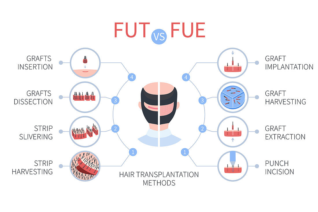 FUE vs FUT hair transplantation, illustration