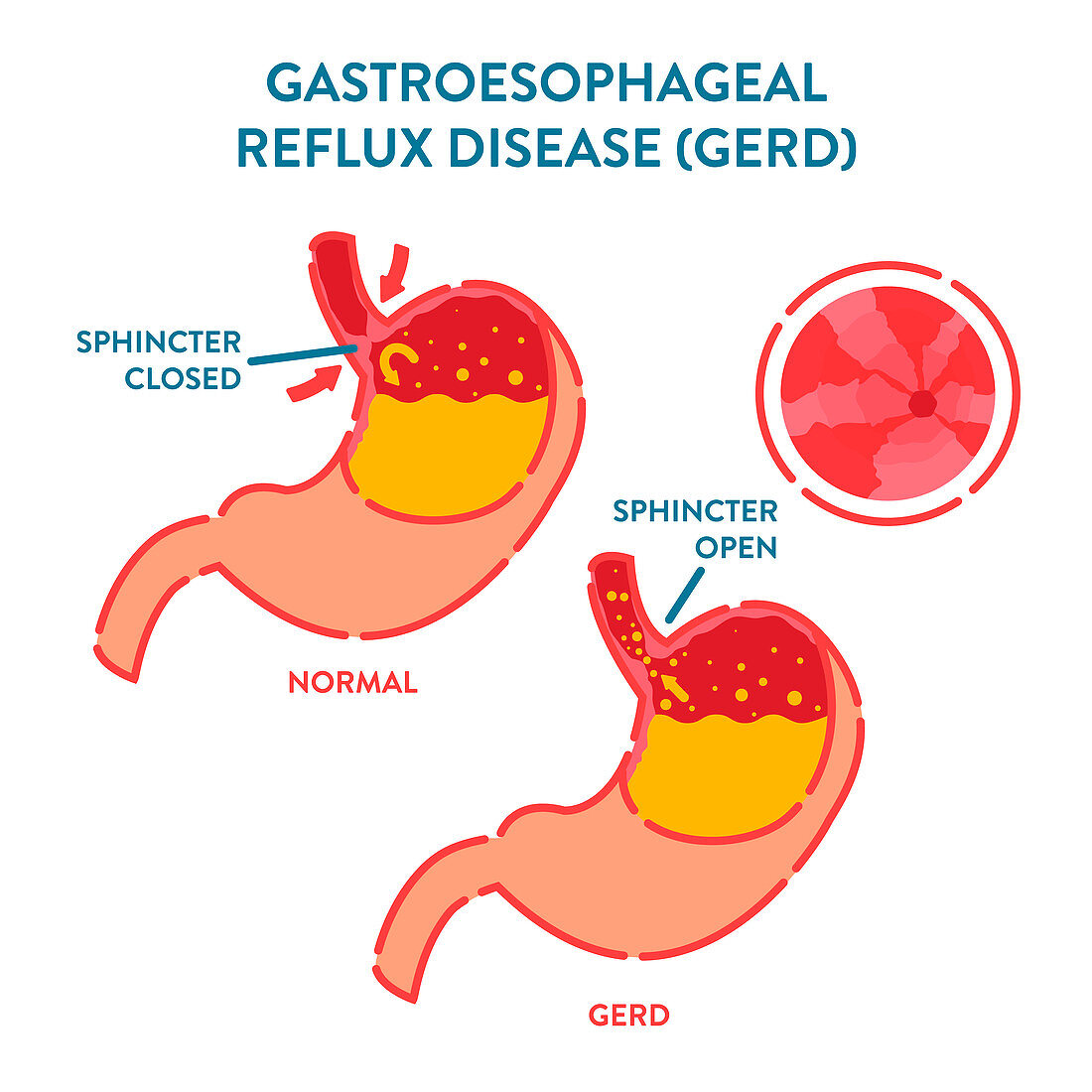 Gastroesophageal reflux disease, illustration