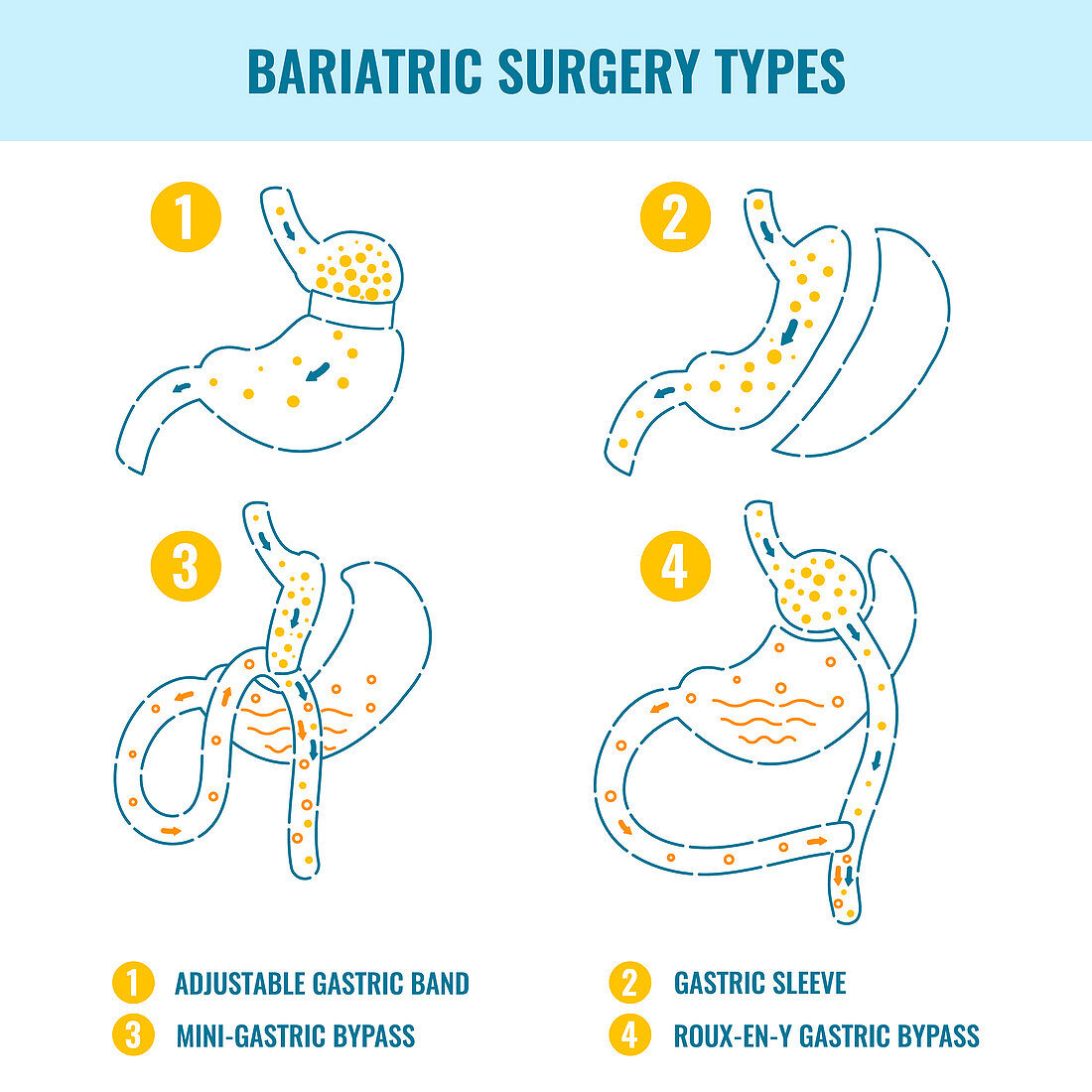 Bariatric surgery types, illustration