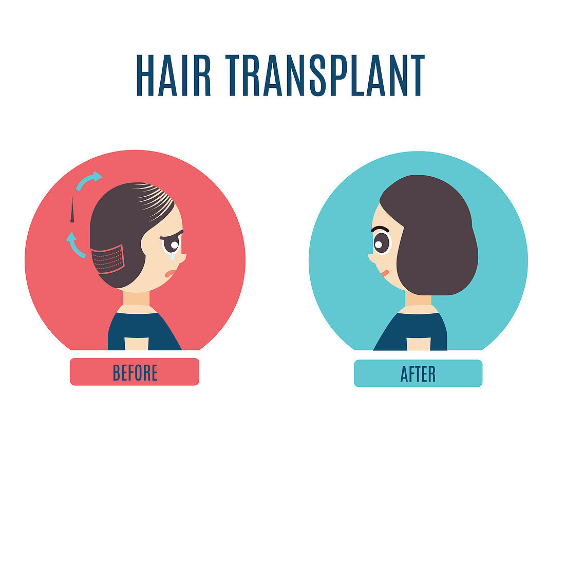 Female hair transplant, illustration