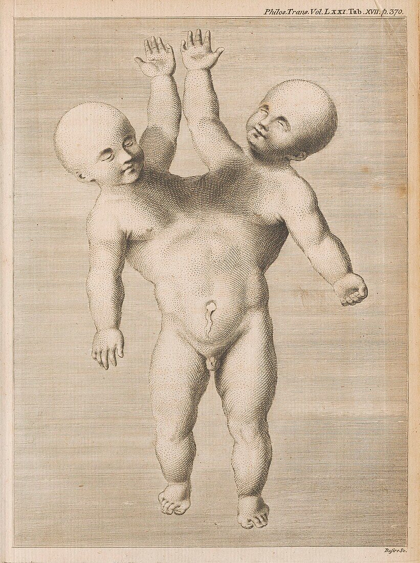 Conjoined twins, 18th century illustration