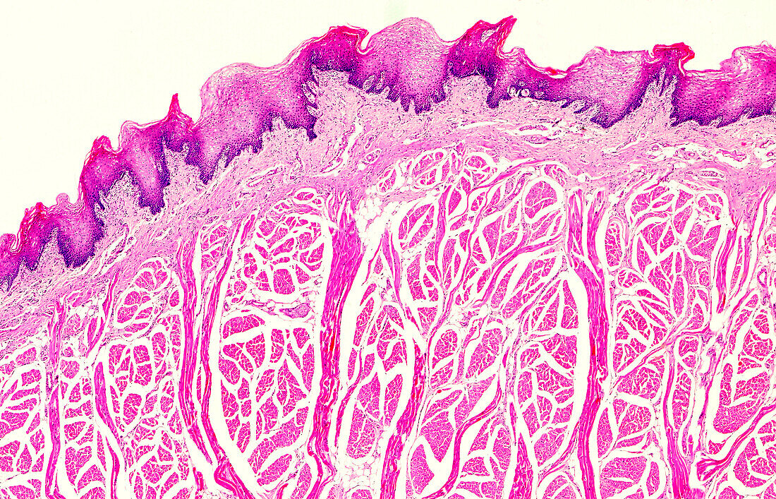 Oropharyngeal cancer, light micrograph