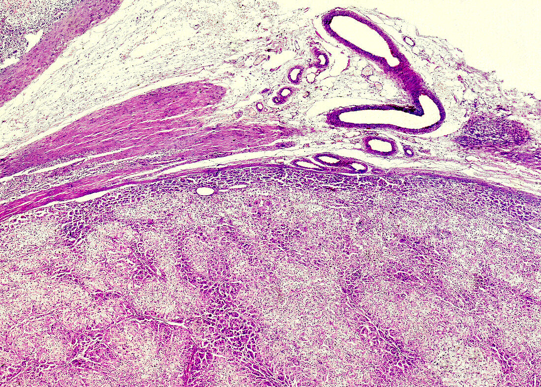 Pheochromocytoma, light micrograph