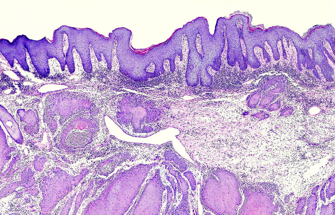Squamous cell carcinoma of the skin, light micrograph