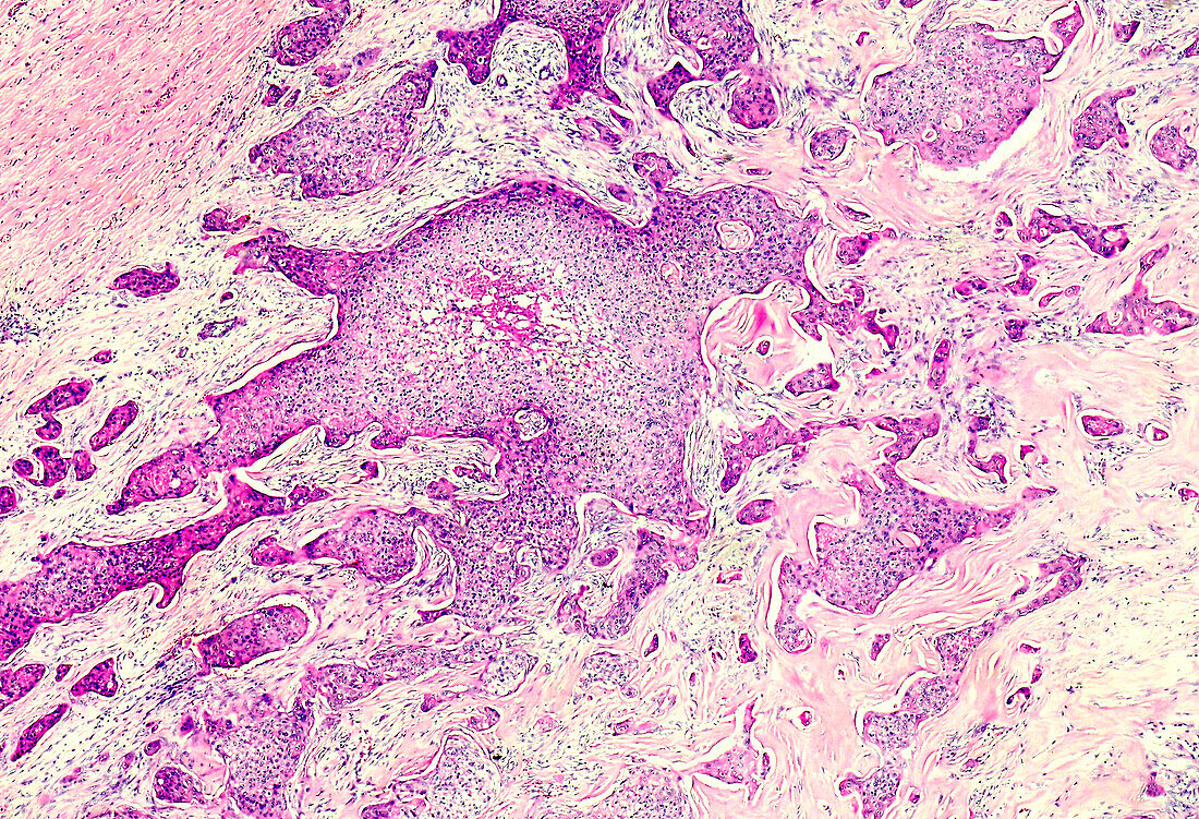 Nevoid basal cell carcinoma syndrome, light micrograph