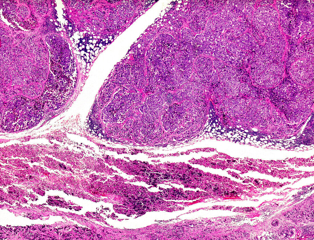 Thymoma and thymic carcinoma, light micrograph