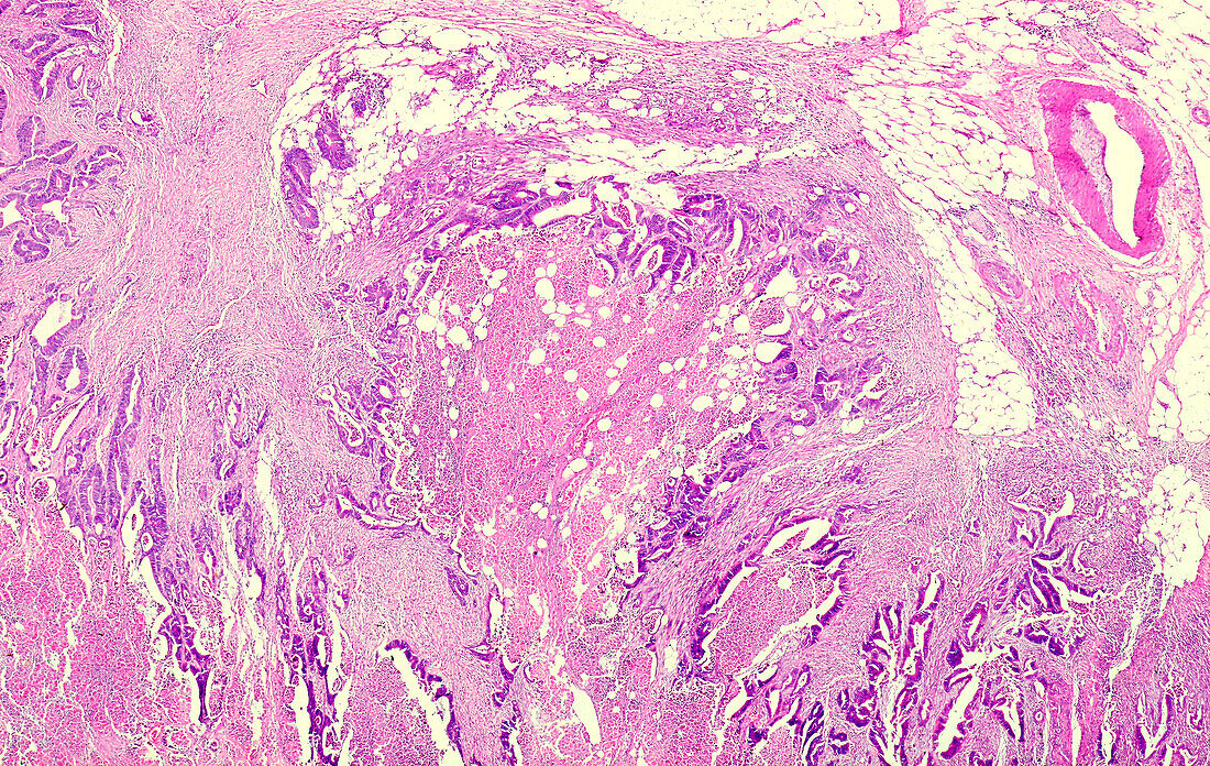 Gastrointestinal stromal tumour, light micrograph