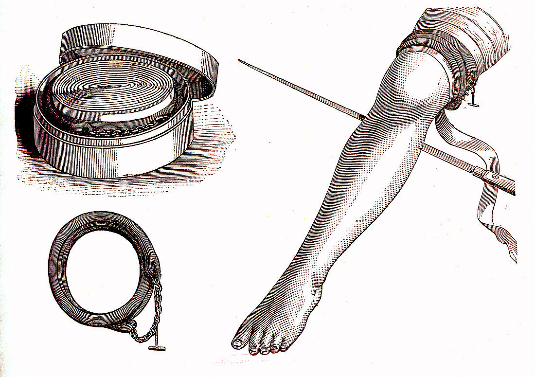 Lower leg amputation, 19th century illustration