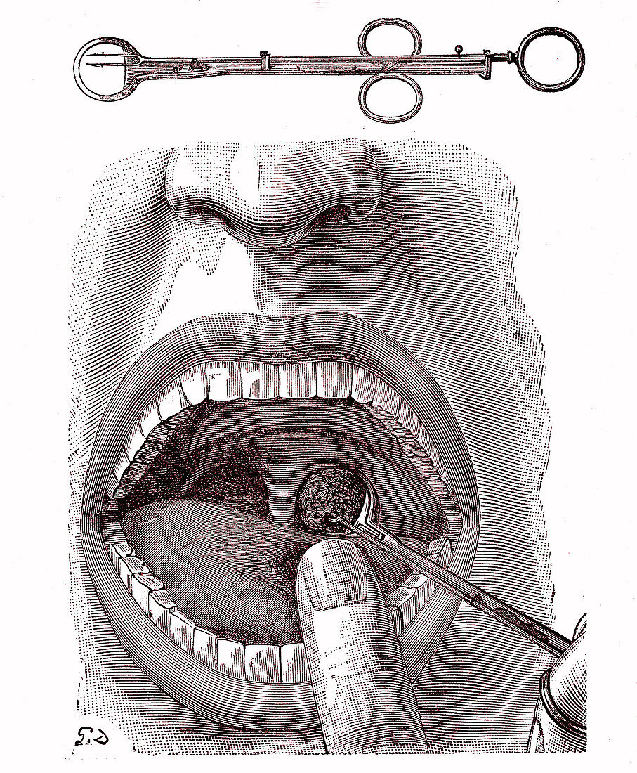 Tonsillectomy, 19th century illustration