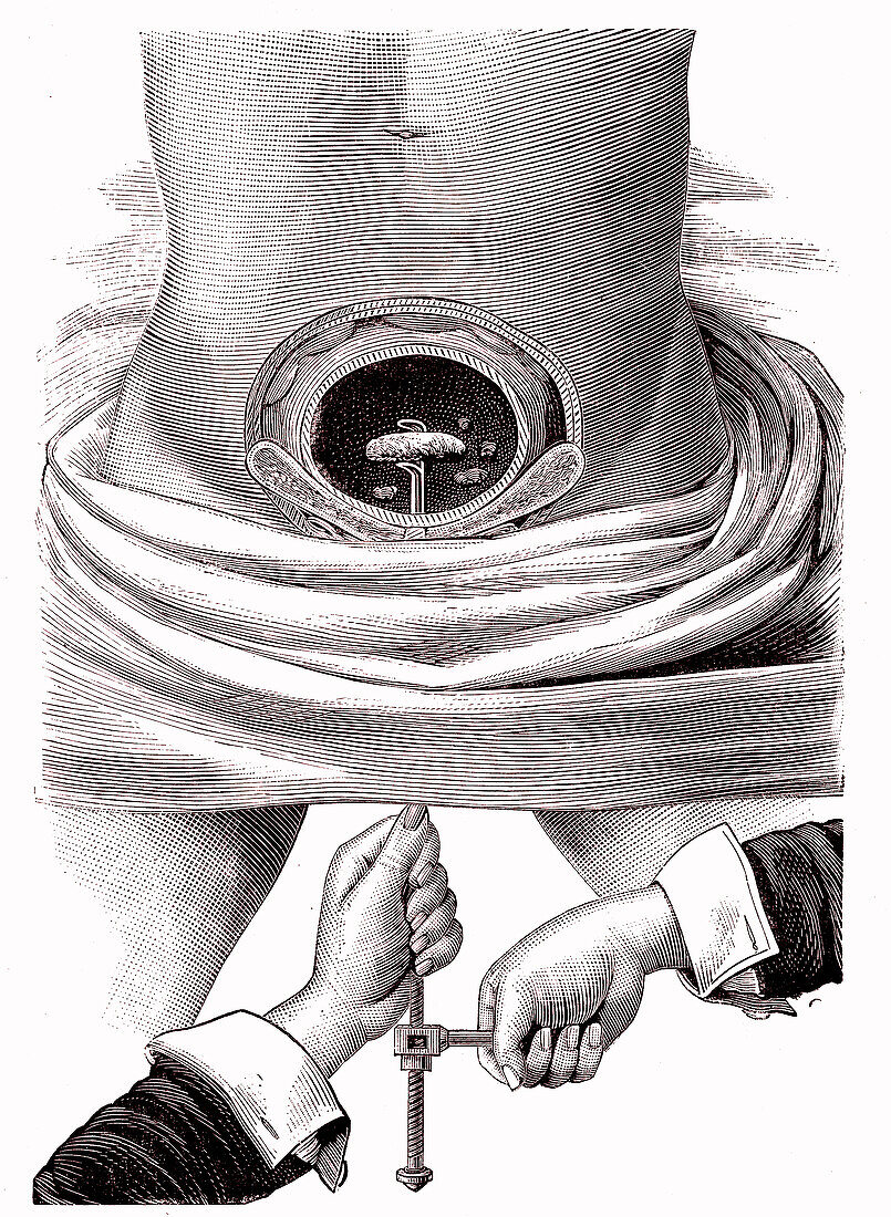 Bladder stone removal, 19th century illustration