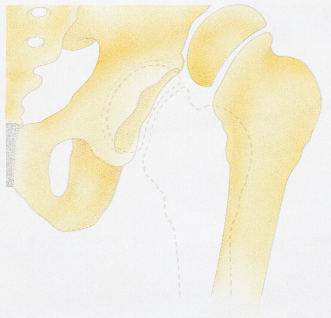 Dislocated hip joint, illustration