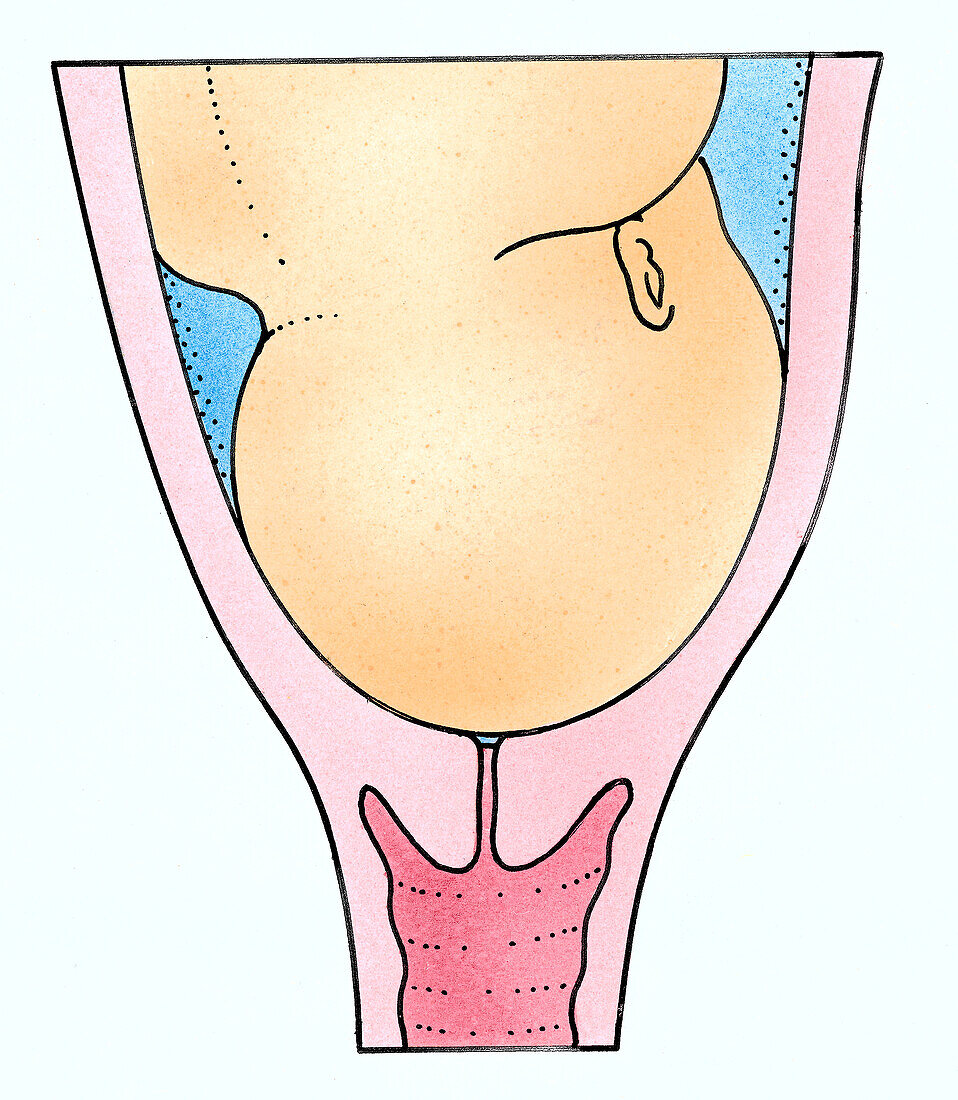 Baby's head resting on dilating cervix, illustration