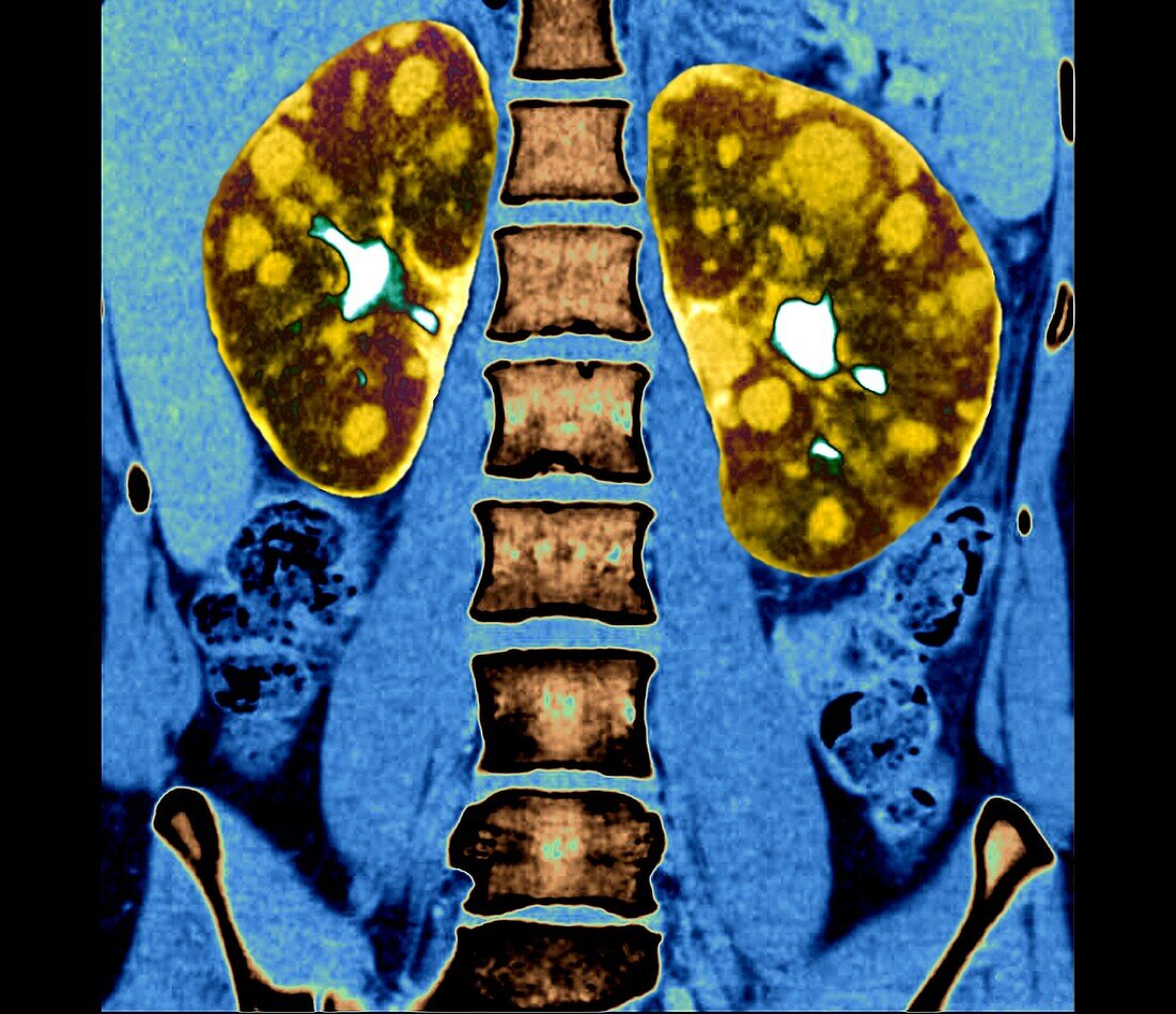 Polycystic kidneys, CT scan