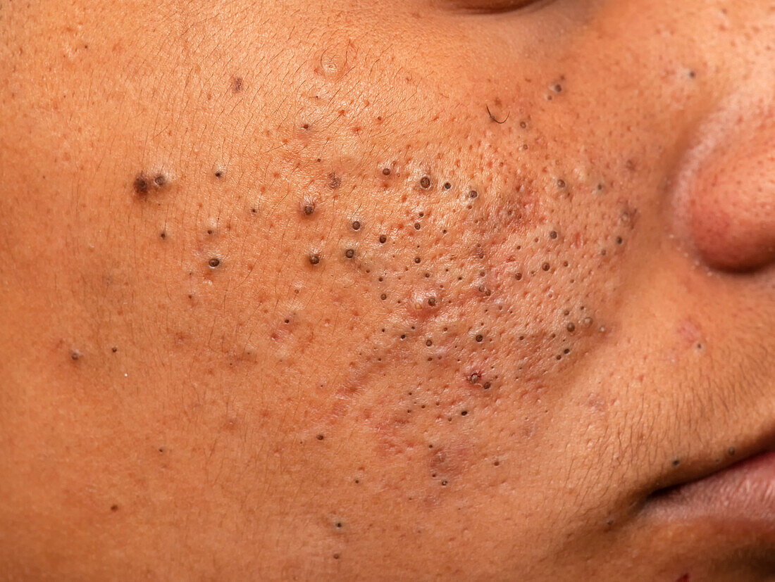 Acne vulgaris