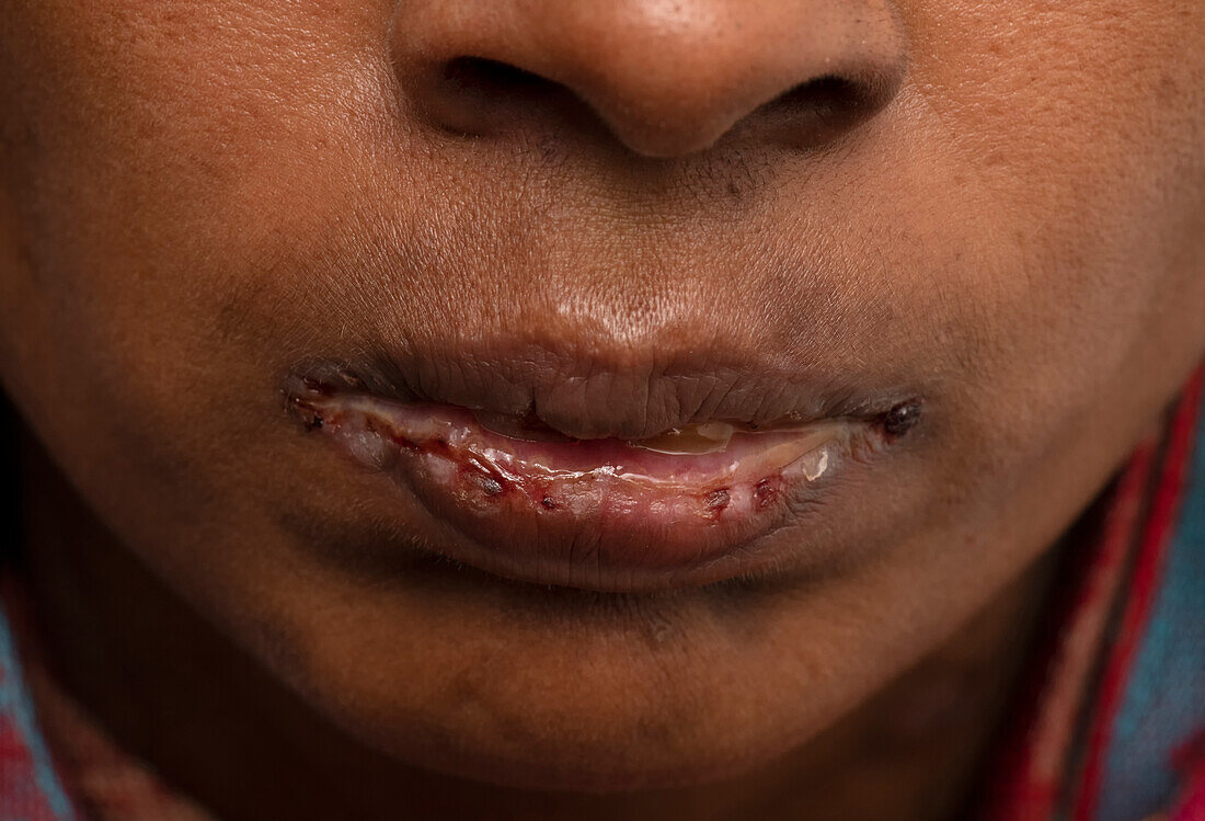 Oral pemphigus vulgaris