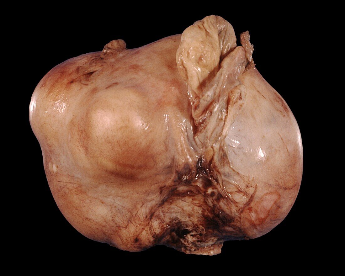Uterine fibroids