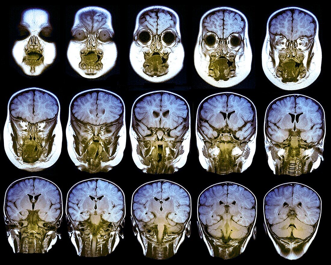 Child brain, MRI scans
