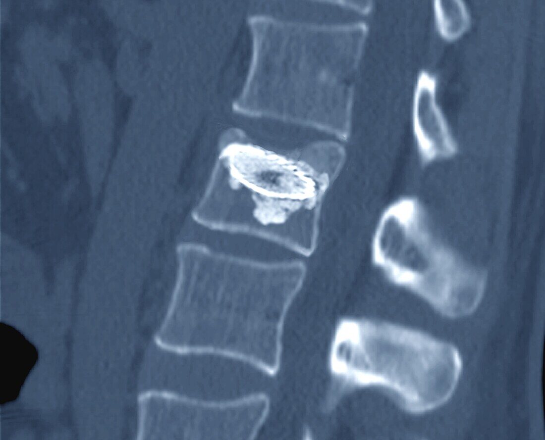 Vertebral body stenting, CT scan