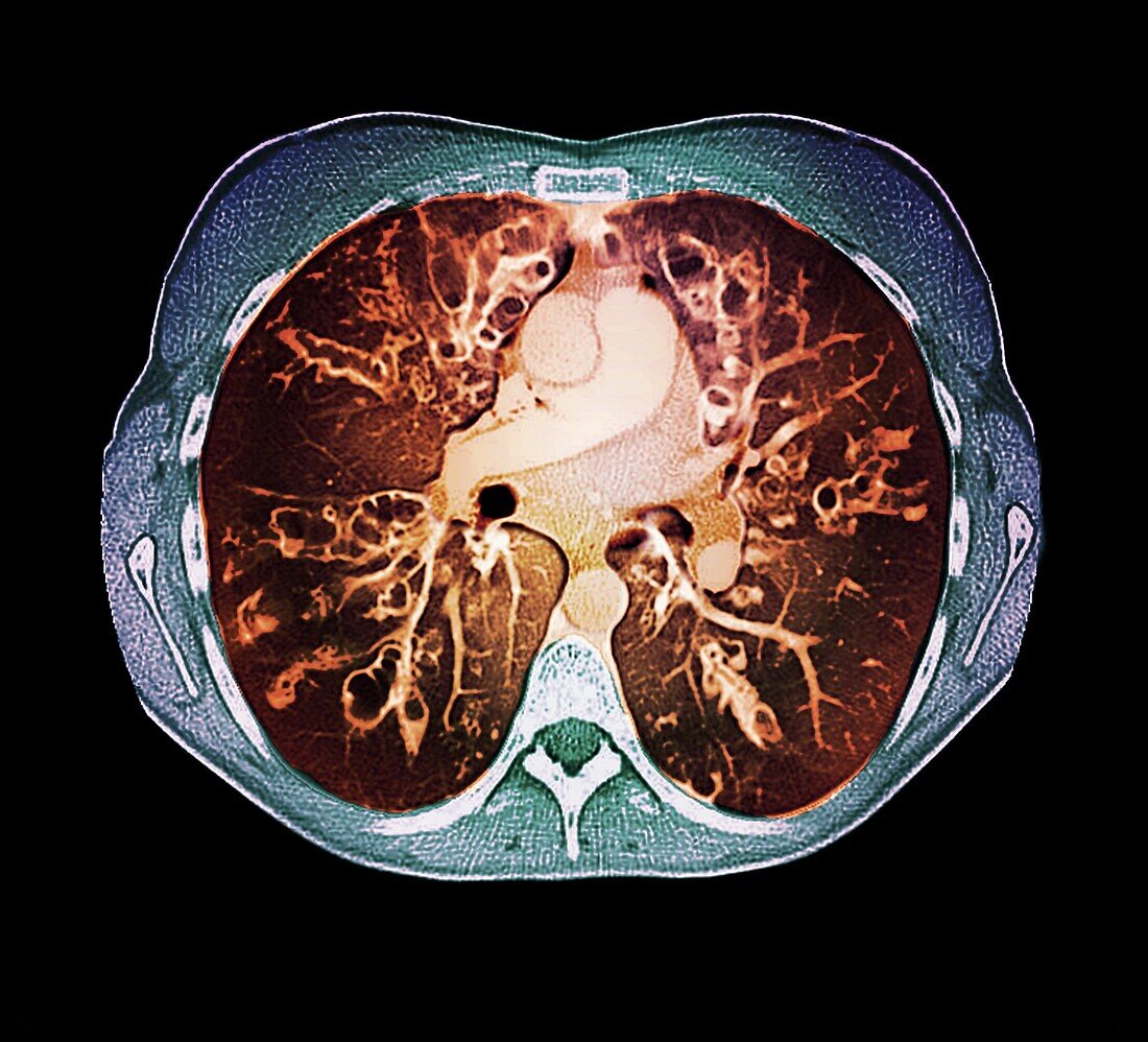 Cystic fibrosis, CT scan