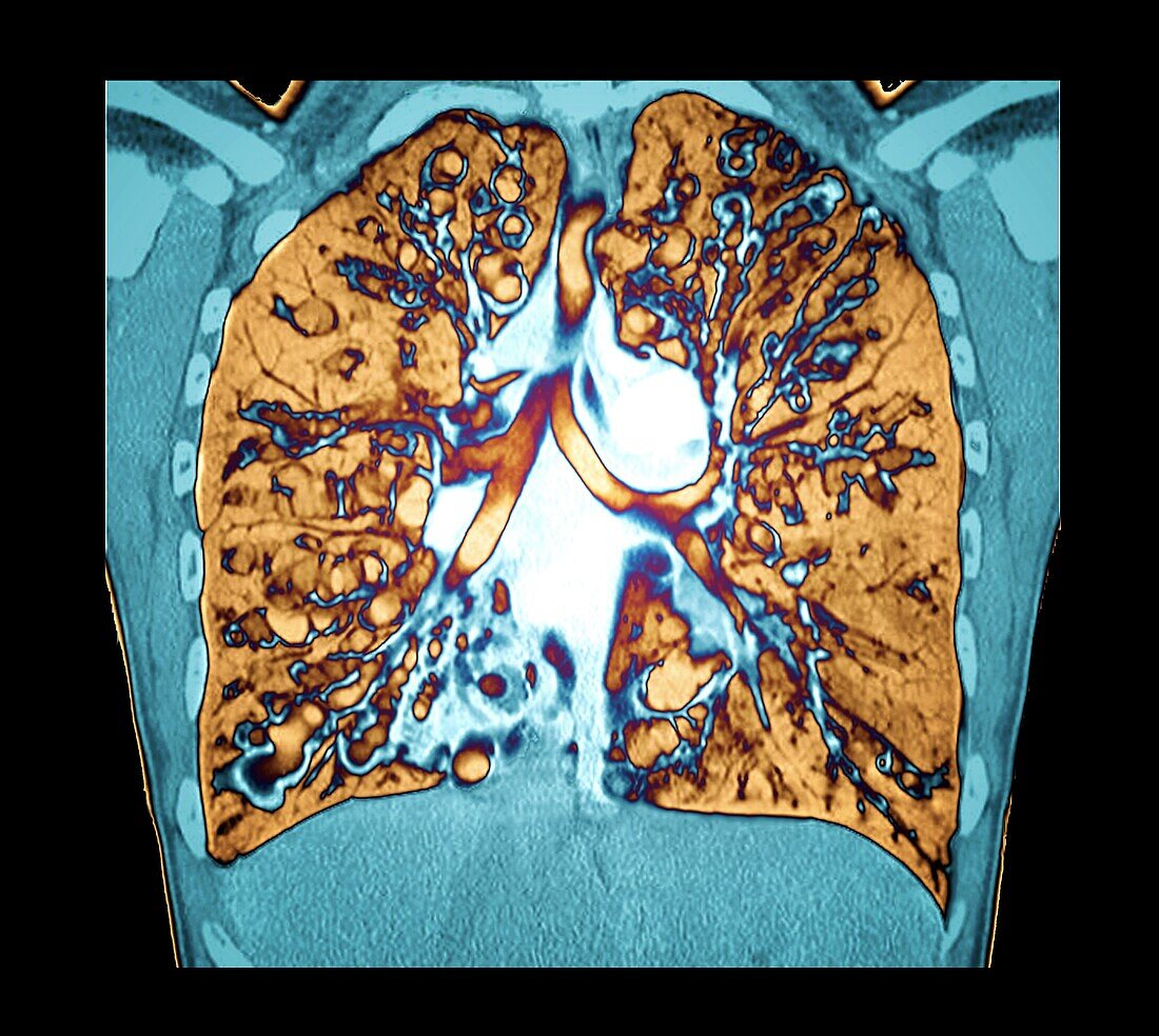 Cystic fibrosis, CT scan