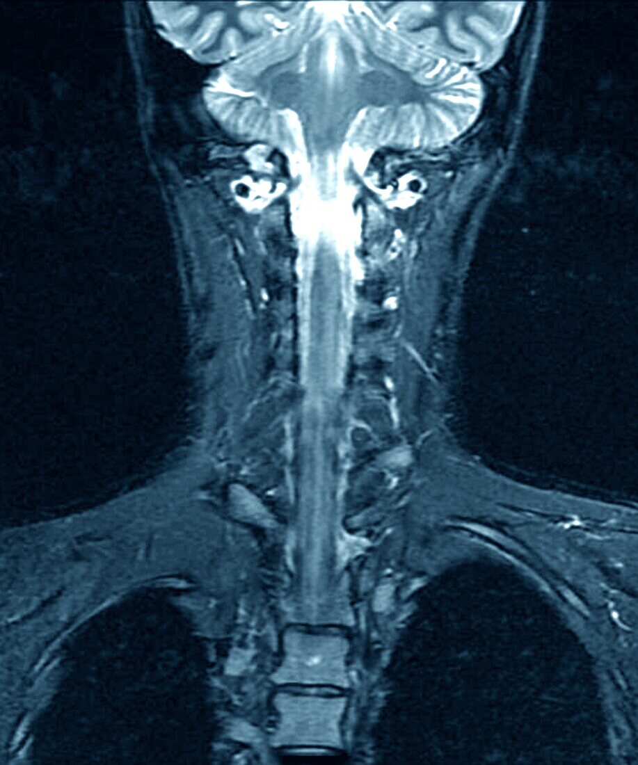 Healthy brain and spinal cord, MRI scan