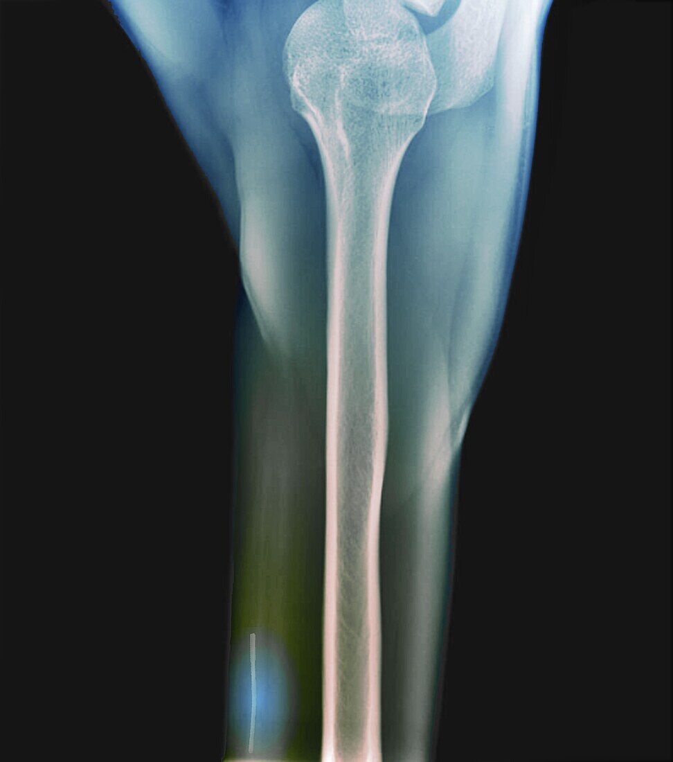 Contraceptive implant, X-ray