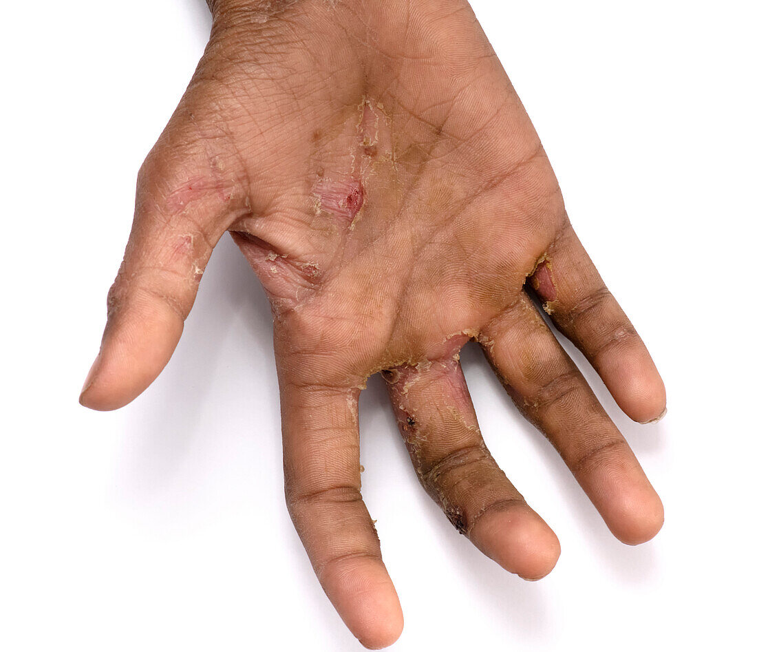 Scabies infection on the skin