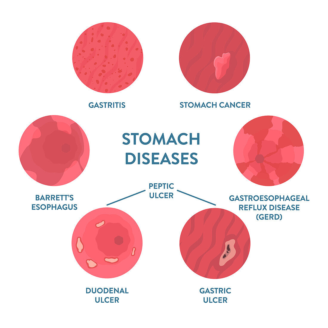 Stomach diseases, illustration