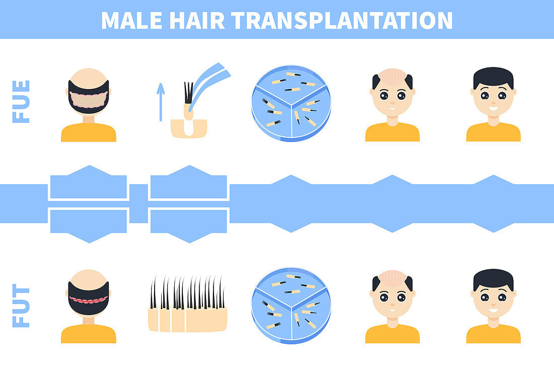 Hair transplantation in men, illustration