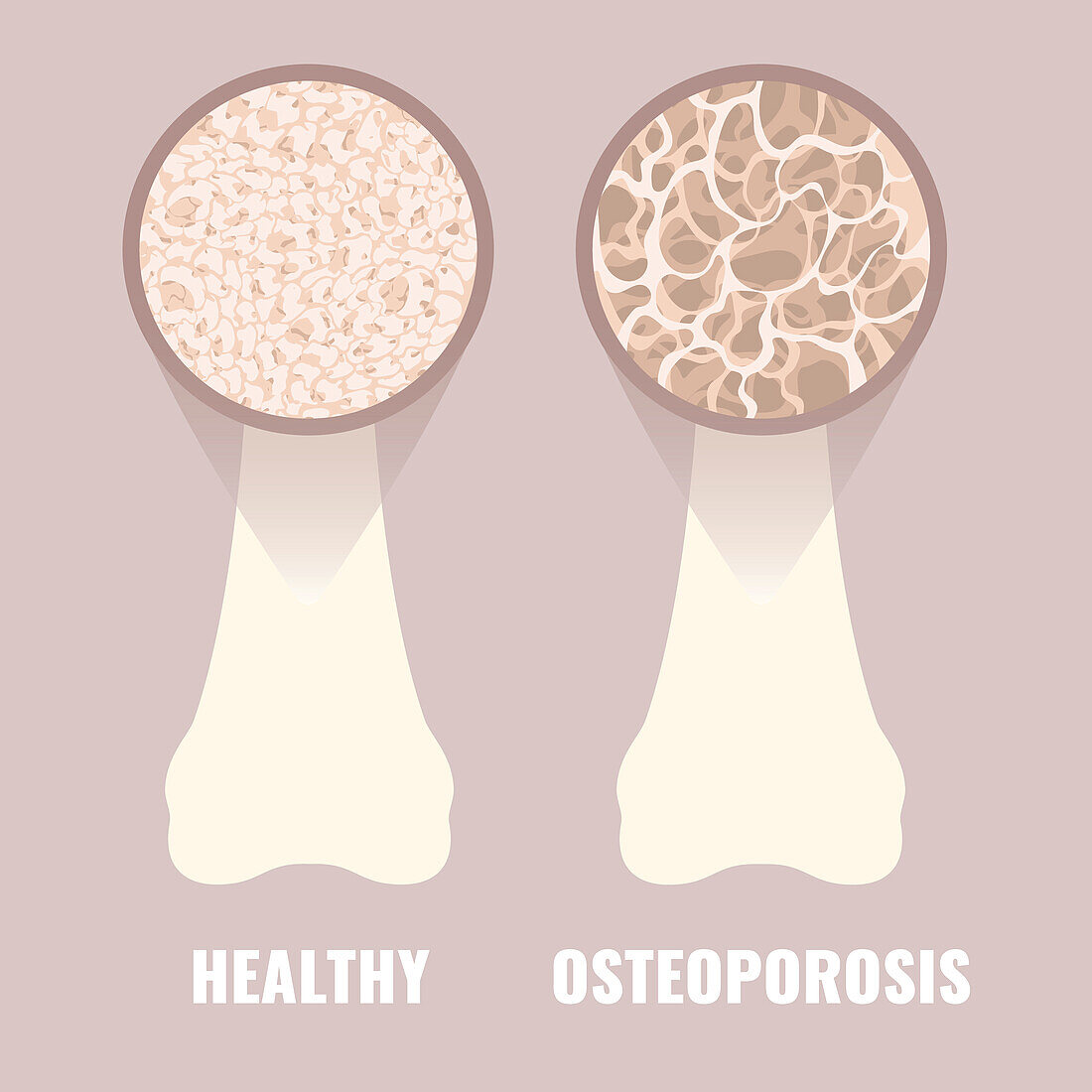 Osteoporosis, conceptual illustration