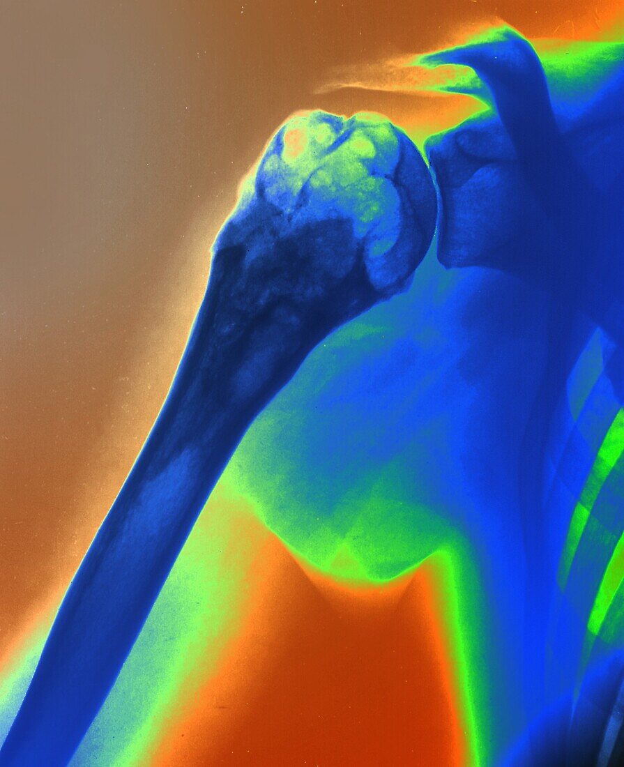 Aneurysmal bone cyst, X-ray