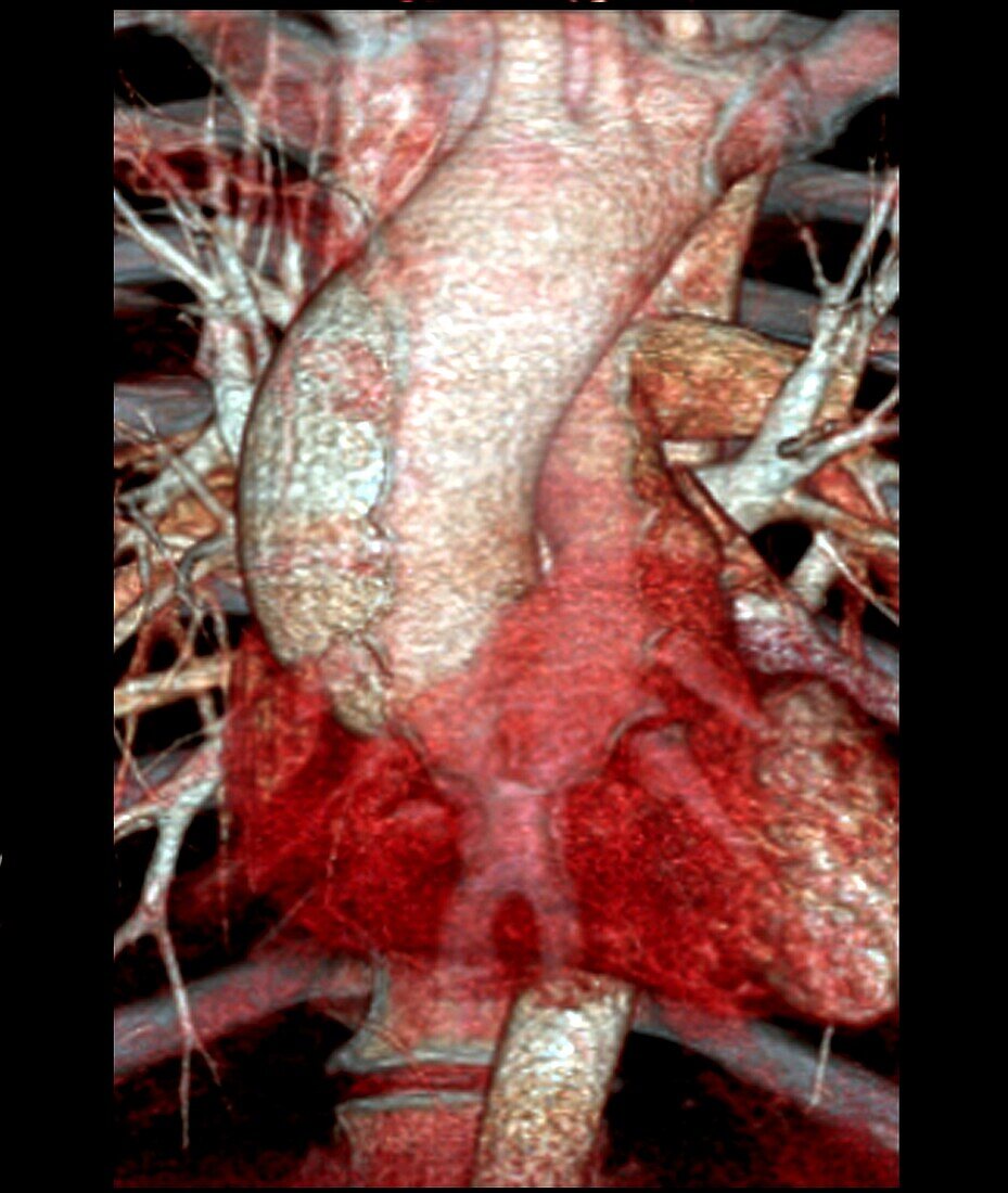 Aortic aneurysm, 3D CT angiogram scan