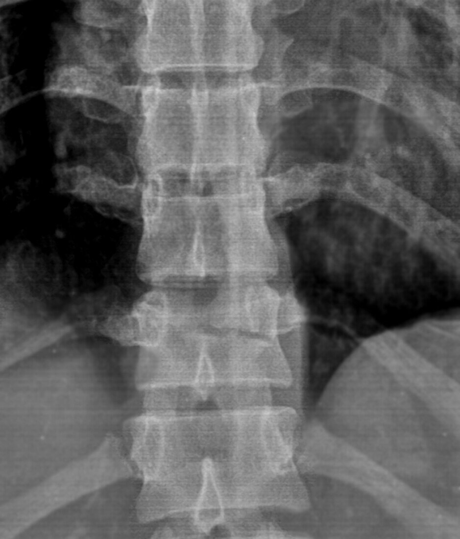 Thoracic spine fracture, X-ray