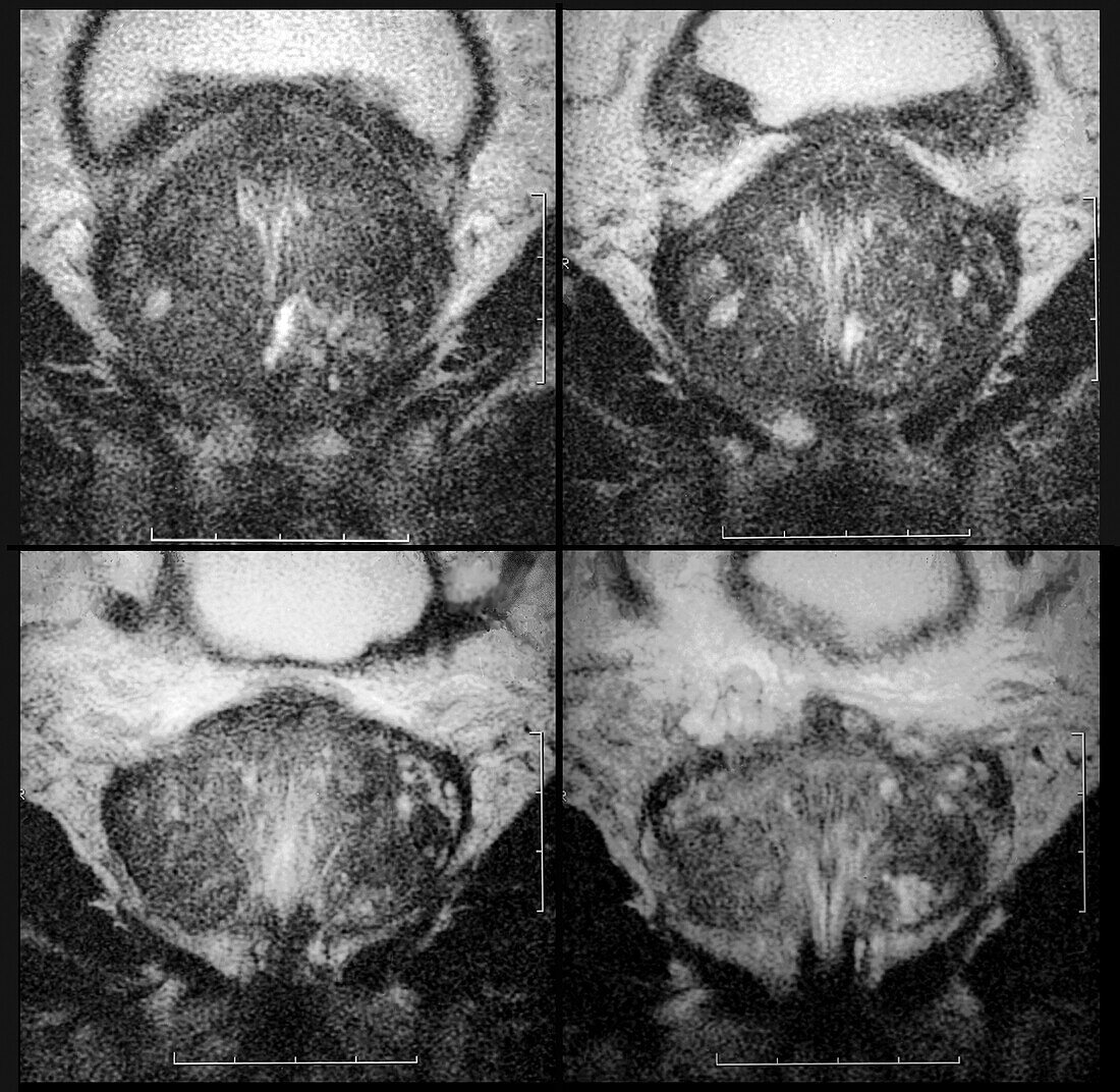 Prostate cancer, MRI scan