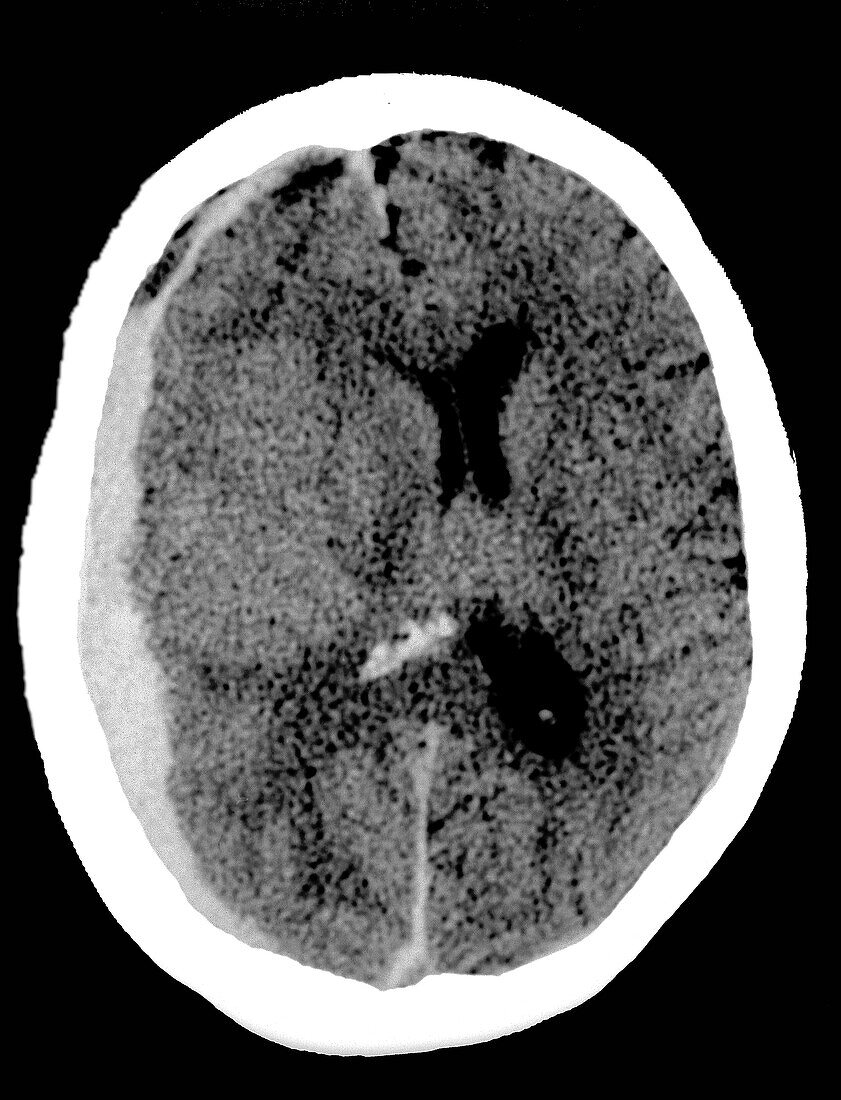 Subdural haematoma, CT scan