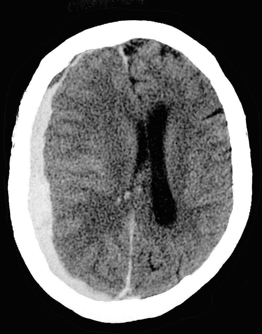 Subdural haematoma, CT scan