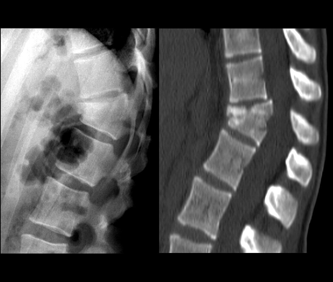 Thoracic spine fracture, X-ray and CT scan