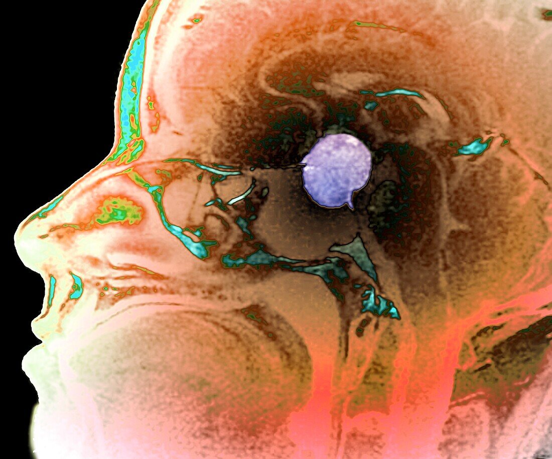 Pituitary macroadenoma, MRI scan